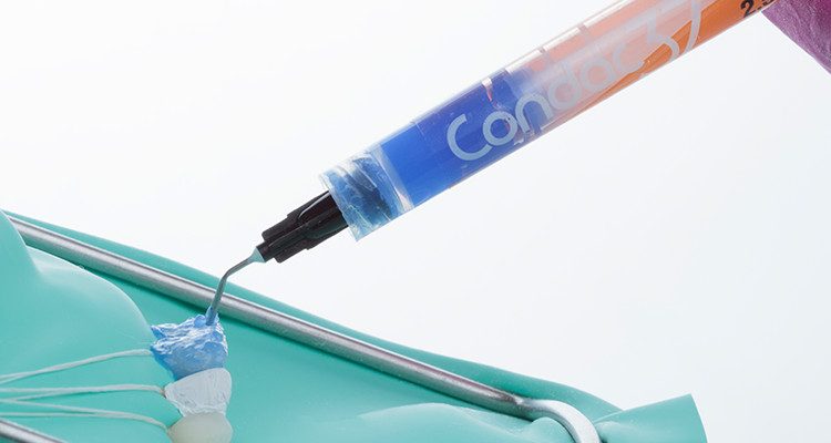 Caso 17 22 - Substituição de facetas em resina composta associada à otimização do substrato por meio de clareamento dental 22 | Condicionamento ácido Condac 37.
