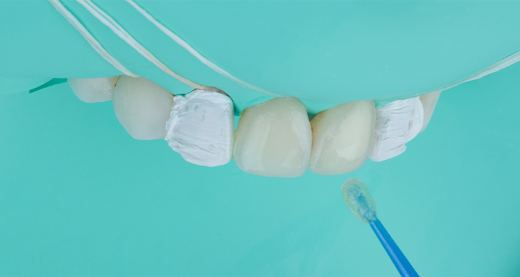 Caso 17 24 - Substituição de facetas em resina composta associada à otimização do substrato por meio de clareamento dental 24 | Aplicação do adesivo Ambar Universal APS Plus.
