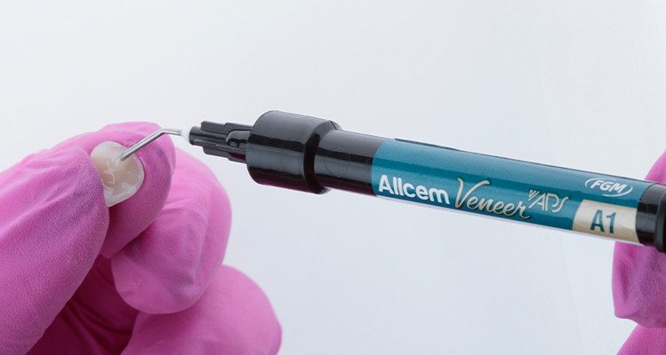 Caso 17 25 - Substituição de facetas em resina composta associada à otimização do substrato por meio de clareamento dental 25 | Aplicação do cimento resinoso Allcem Veneer APS, na cor A1, na faceta.