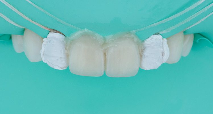 Caso 17 26 - Substituição de facetas em resina composta associada à otimização do substrato por meio de clareamento dental 26 | Facetas em posição previamente a fotopolimerização do cimento resinoso Allcem Veneer APS.