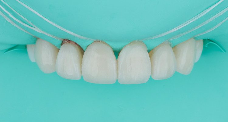 Caso 17 27 - Substituição de facetas em resina composta associada à otimização do substrato por meio de clareamento dental 27 e 28 | Pós-cimentação.