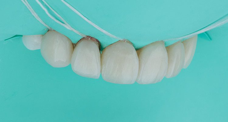 Caso 17 28 - Substituição de facetas em resina composta associada à otimização do substrato por meio de clareamento dental 27 e 28 | Pós-cimentação.