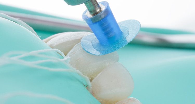 Caso 17 29 - Substituição de facetas em resina composta associada à otimização do substrato por meio de clareamento dental 29 | Acabamento com disco de lixa Diamond Pro.