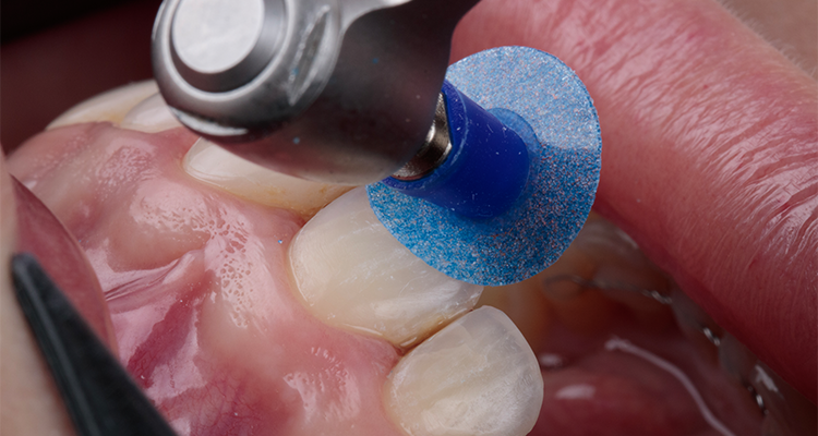 Caso 17 3 - Substituição de facetas em resina composta associada à otimização do substrato por meio de clareamento dental 3 | Remoção das facetas em resina com Diamond Pro.