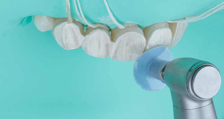 Caso 17 31 - Substituição de facetas em resina composta associada à otimização do substrato por meio de clareamento dental 31 | Aplicação da pasta de polimento Diamond Excel Ultrafine com disco de feltro Diamond Flex.