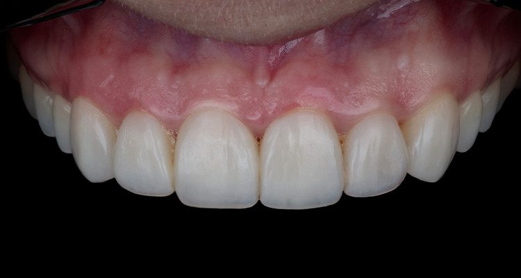 Caso 17 32 - Substituição de facetas em resina composta associada à otimização do substrato por meio de clareamento dental 32 | Foto final intraoral frontal, com fundo preto.