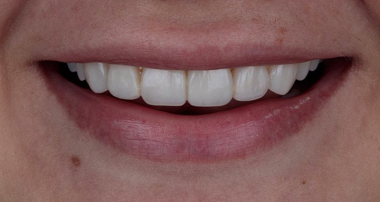 Caso 17 33 - Substituição de facetas em resina composta associada à otimização do substrato por meio de clareamento dental 33 | Sorriso frontal final.