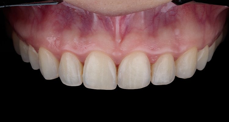 Caso 17 4 - Substituição de facetas em resina composta associada à otimização do substrato por meio de clareamento dental 4 | Foto intraoral após remoção das facetas.