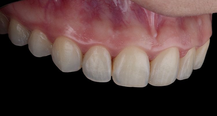 Caso 17 5 - Substituição de facetas em resina composta associada à otimização do substrato por meio de clareamento dental 5 | Foto intraoral lateral direita com fundo preto após remoção das facetas.