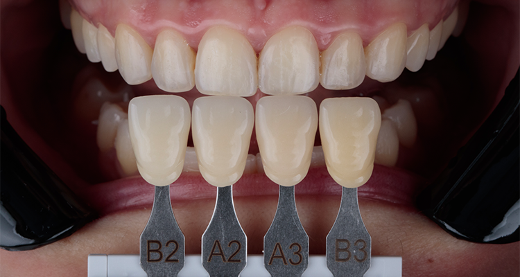 Caso 17 6 - Substituição de facetas em resina composta associada à otimização do substrato por meio de clareamento dental 6 | Registro da cor antes do clareamento.