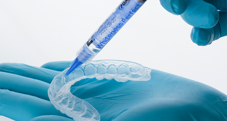 Caso 17 7 - Substituição de facetas em resina composta associada à otimização do substrato por meio de clareamento dental 7 | Aplicação do gel clareador Whiteness Perfect 16% na moldeira Whiteness.