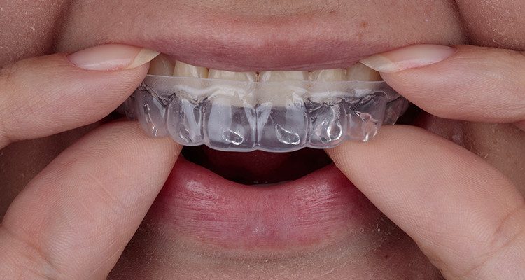 Caso 17 8 - Substituição de facetas em resina composta associada à otimização do substrato por meio de clareamento dental 8 | Inserção da moldeira Whiteness com o gel clareador Whiteness Perfect 16% na boca.