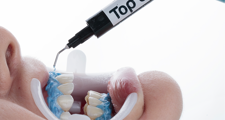 Caso 17 9 - Substituição de facetas em resina composta associada à otimização do substrato por meio de clareamento dental 9 | Aplicação da barreira gengival Top Dam