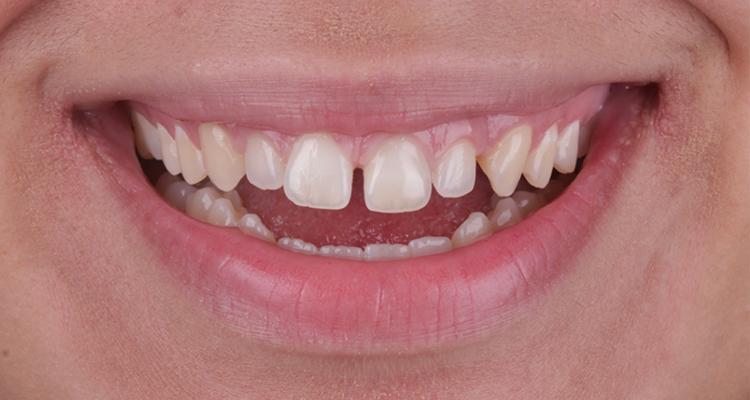 1 | Aspecto inicial do sorriso, em vista frontal. diastemas