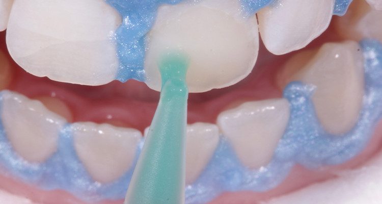 10 A | Aplicação do gel clareador Whiteness HP AutoMixx 35% Plus.