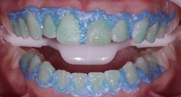 10B | Aplicação total do gel clareador Whiteness HP AutoMixx 35% Plus em visão frontal.