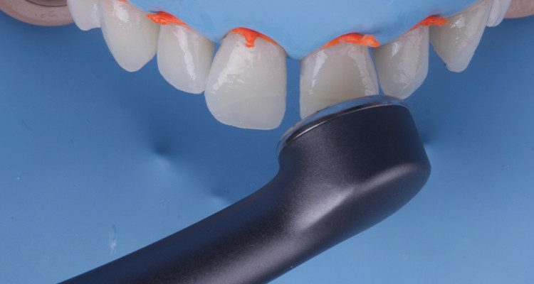 25A e 25B | Fotopolimerização do adesivo com fotopolimerizador Quazar