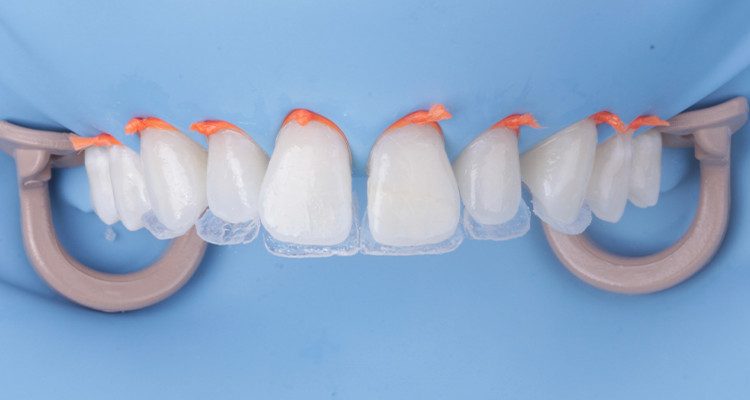 27 | Concha palatina em todos os dentes