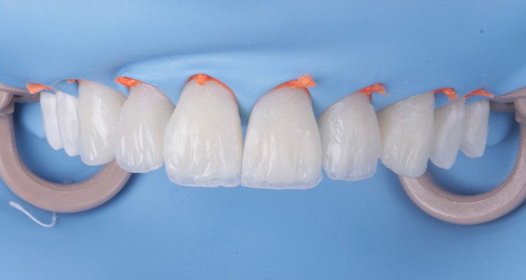 30 | Finalização da camada de dentina.