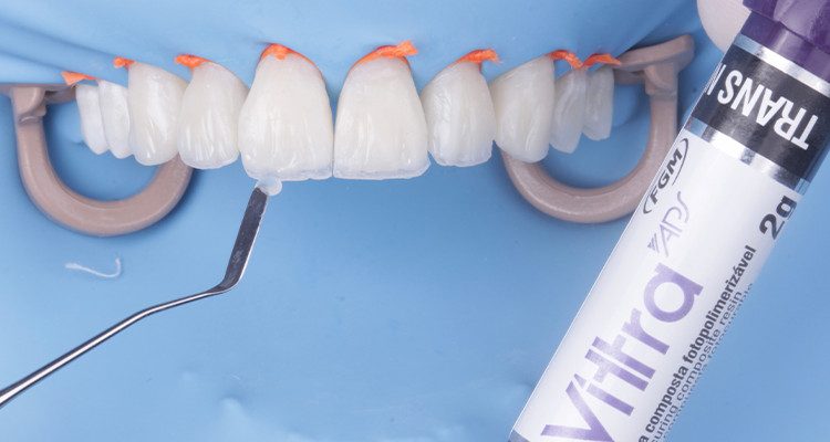 31 | Resina Vittra APS Trans N na borda incisal.