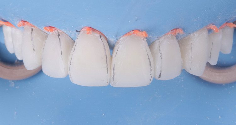 34 | Marcação das arestas.