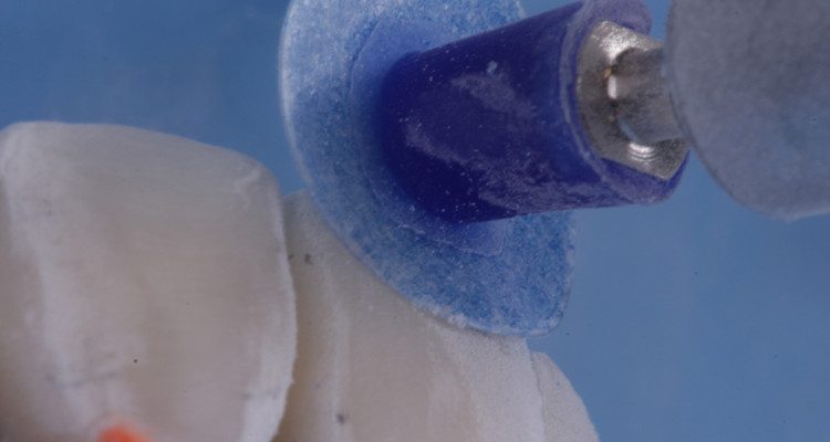 35 | Ajuste dos terços com os discos de lixa Diamond Pro