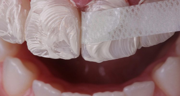 40B | Interproximal e com lixa.