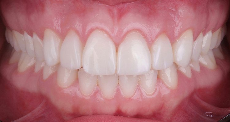 43 | Aspecto intraoral após 15 dias