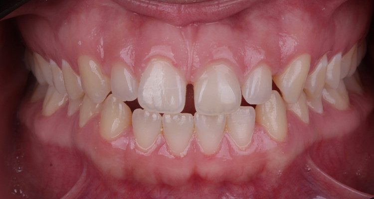 4 | Aspecto intraoral, em visão frontal.