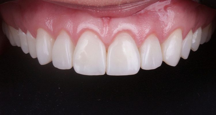 44 | Aspecto final intraoral com contraste