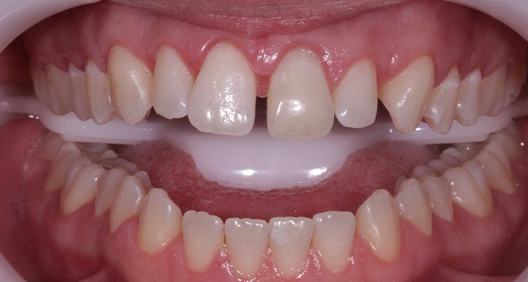 7 | Intraoral com afastador Arcflex para clareamento.
