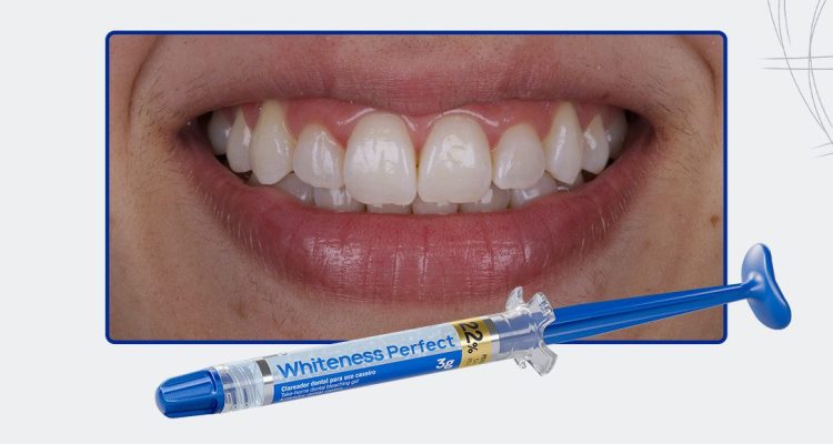 02_Capa-Clareamento-Caseiro-Supervisionado-Com-Whiteness-Perfect-22%