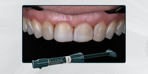 2026-Caso-12_Capa-Facetas-em-resina-composta-com-elóra-aps