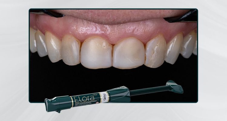 2026-Caso-12_Capa-Facetas-em-resina-composta-com-elóra-aps