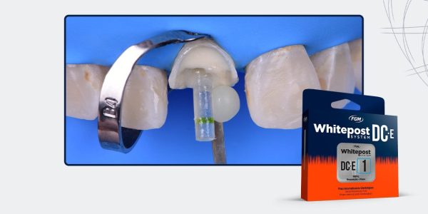 21_Capa-Restauração-Estética-Com-Pino-De-Fibra-De-Vidro-E-Resina-Composta