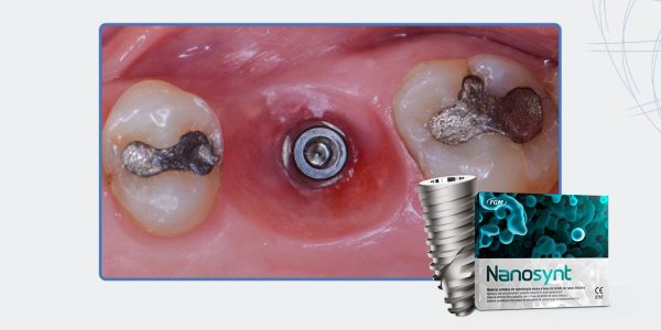 23_Capa-Implante-Imediato-e-Cicatrizador-Personalizado-Para-Manutenção-Do-Contorno-Tecidual-Em-Região-Molar