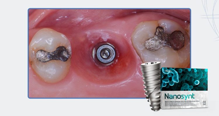 23_Capa-Implante-Imediato-e-Cicatrizador-Personalizado-Para-Manutenção-Do-Contorno-Tecidual-Em-Região-Molar