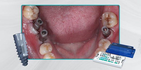 35_Capa-Carga-imediata-com-próteses-provisórias-confeccionadas-pelo-fluxo-digital