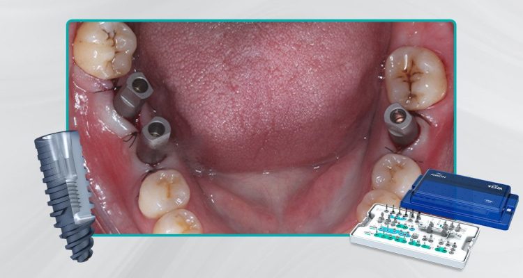 35_Capa-Carga-imediata-com-próteses-provisórias-confeccionadas-pelo-fluxo-digital