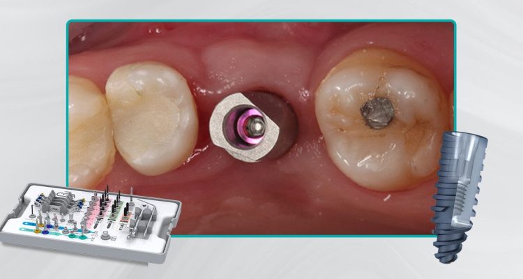 36_Capa-Cirurgia-guiada-em-área-com-defeito-vestibular-de-rebordo2