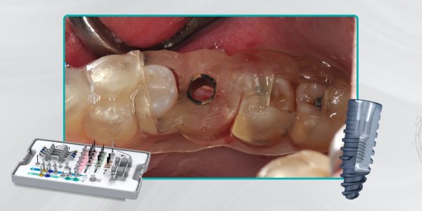 36_Capa-Cirurgia-guiada-em-área-com-defeito-vestibular-de-rebordo3