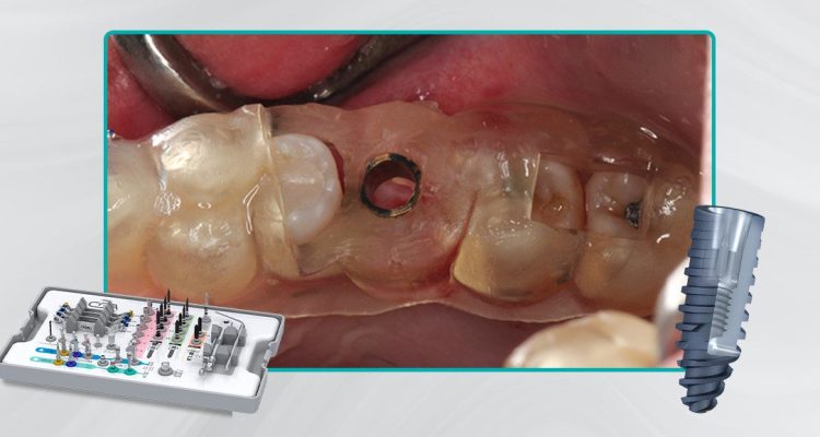 36_Capa-Cirurgia-guiada-em-área-com-defeito-vestibular-de-rebordo3