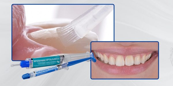 Caso-2_Capa-Técnica-associada-de-clareamento-dental-eficácia-e-ausência-de-sensibilidade