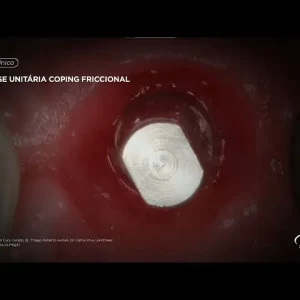 #casoclinico: Prótese unitária coping friccional - FGM Dental Group