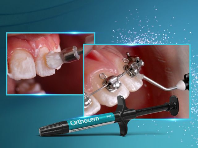 Dispositivos-adesivos-complementares-ao-tratamento-ortodontico-relato-de-caso[1]